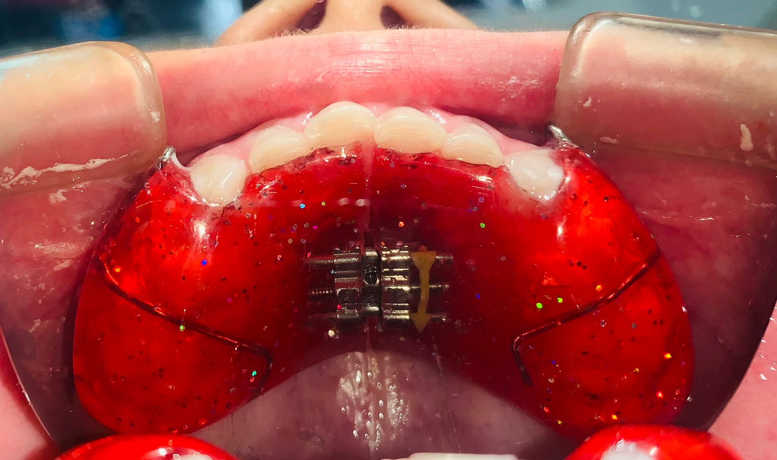 Alivio para tu mandíbula